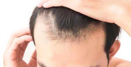 Ankara Saç Dökülme Tedavisi