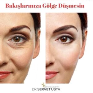 Göz Çevresi Botoksu Ankara
