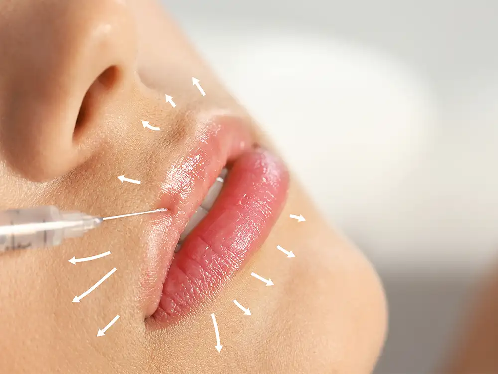 lip lift trendleri