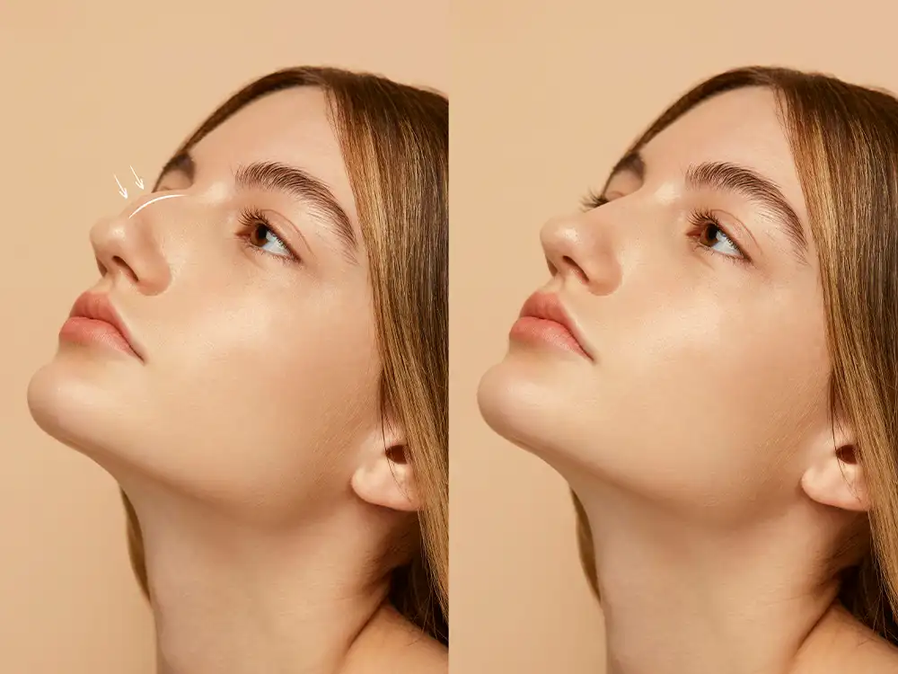 Doğal görünümlü burun dolgusu